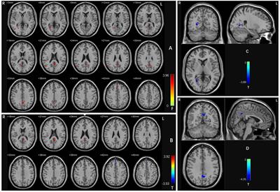 Altered dynamic neural activities in individuals with obsessive-compulsive disorder and comorbid depressive symptoms